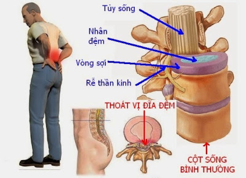 Bệnh thoát vị cột sống thắt lưng