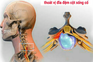 Bệnh thoát vị cột sống cổ