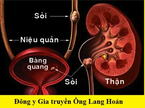 Sỏi thận là bệnh gì?