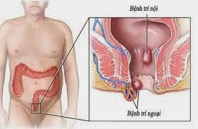 Bệnh trĩ là gì  ?