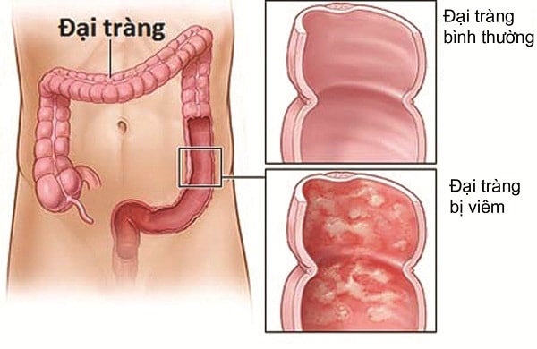 Viêm loét đại tràng là bệnh gì?