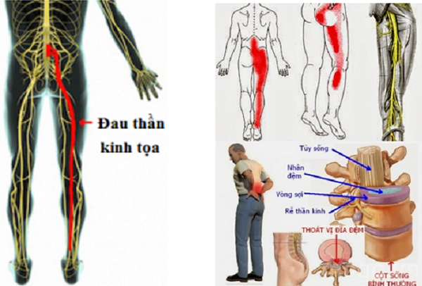 Chữa Khỏi Thoát Vị Đĩa Đệm