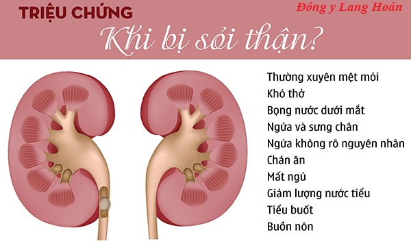 triệu chứng khi mắc sỏi thận