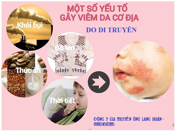 Viêm da cơ địa dị ứng do di truyền